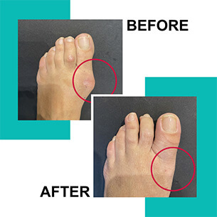 Best practice for bunion surgery in the World, how to get rid of a bunion