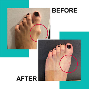 Best Bunion Correction in the World, best practice for bunion surgery, bunion surgery, bunion corrector